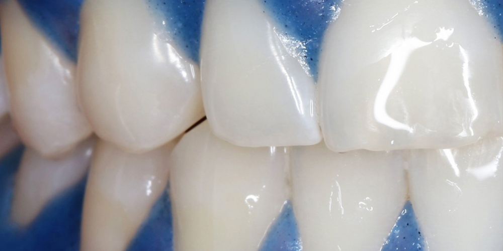  Отбеливание зубов системой отбеливания Zoom 3