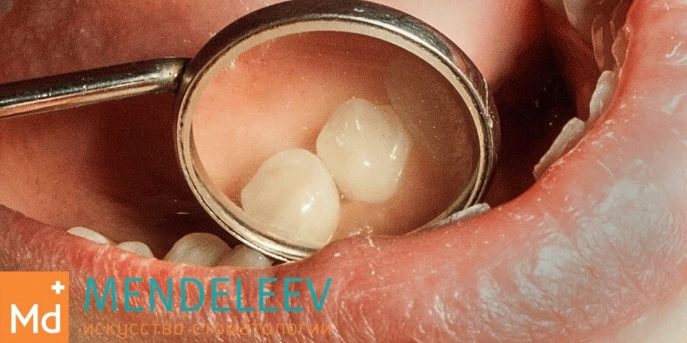  Лечение кариеса зуба 4.4