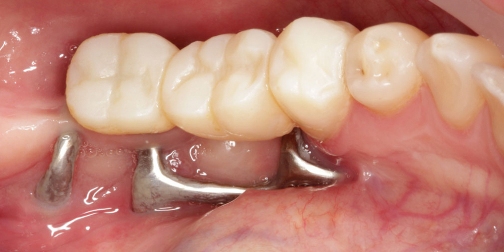  Цельнокерамические реставрации на зубах и имплантатах с опорой на индивидуальные абатменты