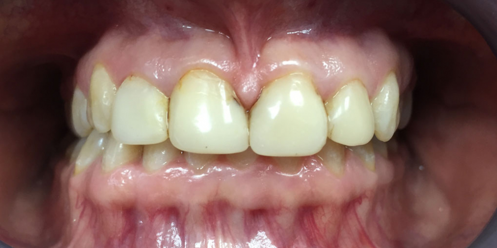  Восстановление эстетики передних зубов керамическими винирами