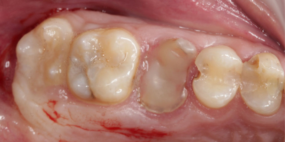До Восстановление зуба имплантацией + синус-лифтинг - все в один этап