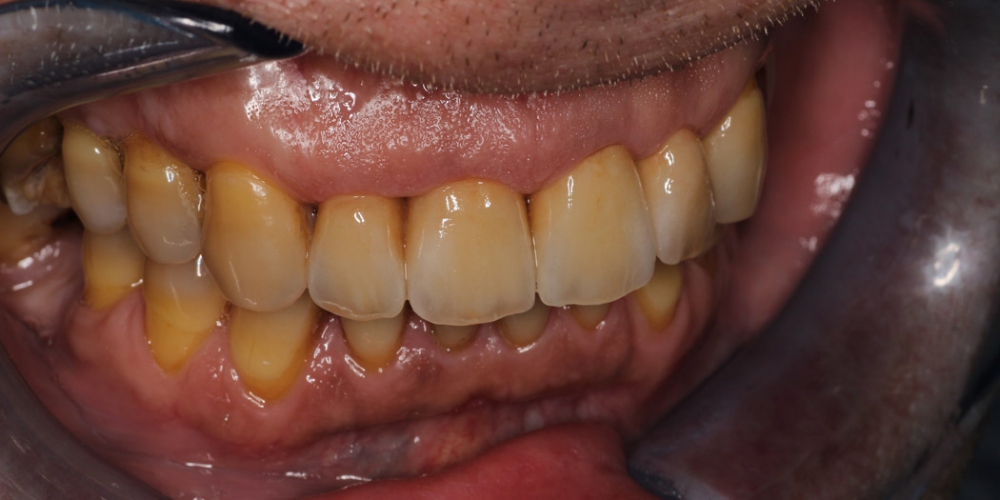  Восстановление передних зубов композитным материалом и коронками