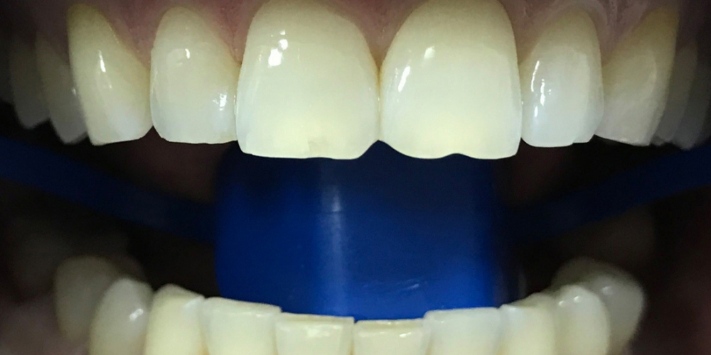  Результат отбеливания зубов системой Зум 3