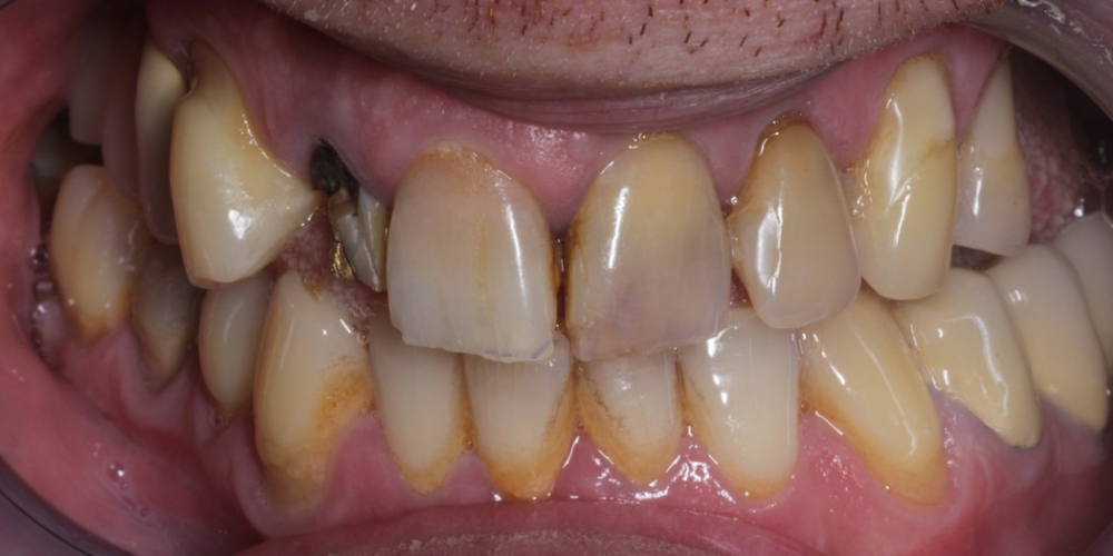  Лечение и протезирование зубов вкладками и металлокерамическими коронками
