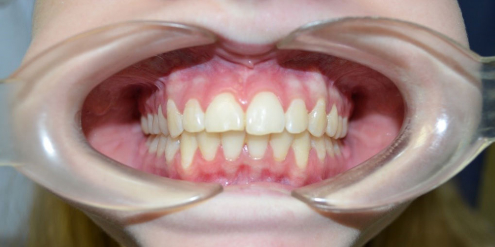  Результат выравнивания зубов на нижней и верхней челюстях