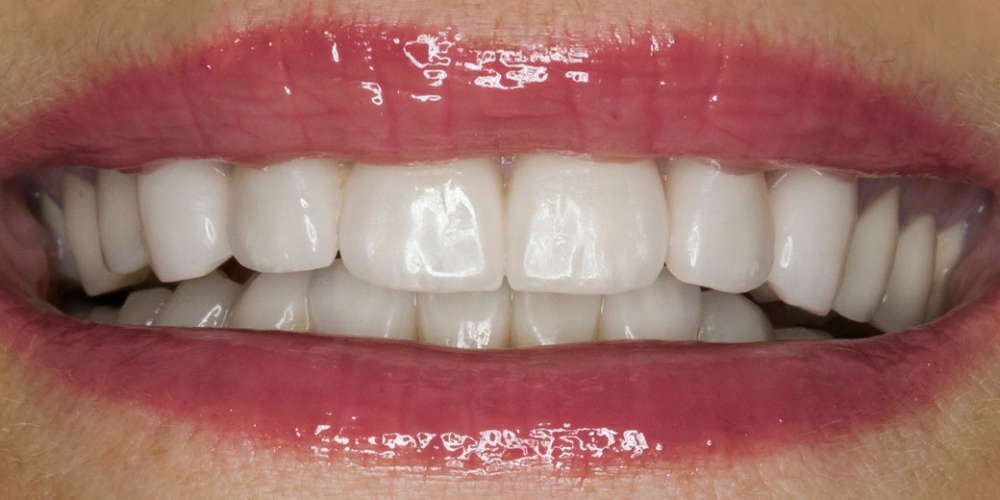  Установка виниров на передние зубы верхней и нижней челюсти