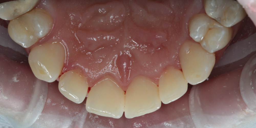 В завершение процедуры на поверхность зубов были нанесены средства для укрепления эмали. 

Пациенту даны рекомендации по правильному уходу за зубами в домашних условиях. Профессиональна гигиена полости рта + чистка Air-Flow