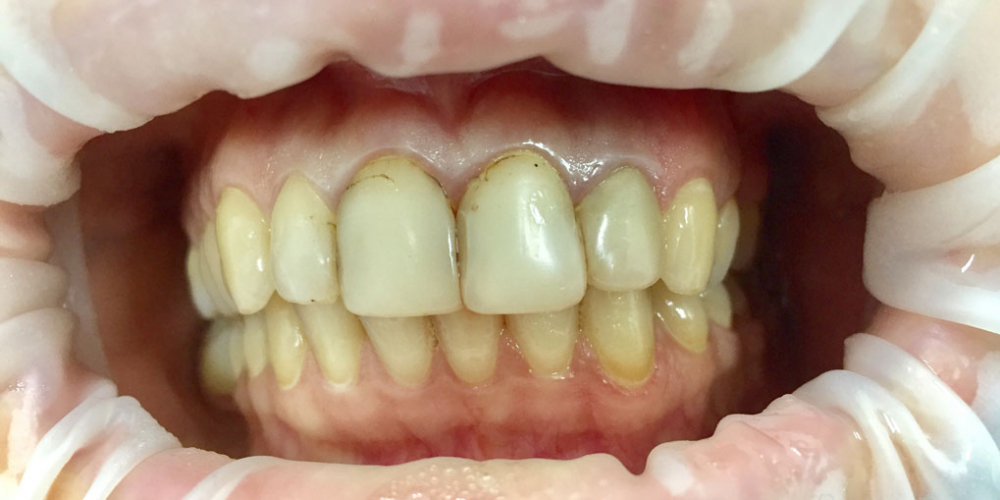  Восстановление эстетики передних зубов керамическими винирами, 4 винира