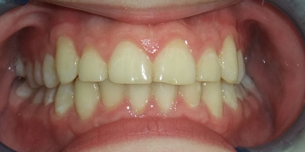  Исправление скрученного положения зубов верхнего и нижнего зубного ряда