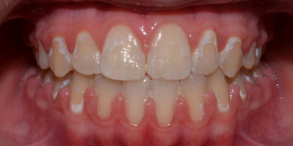  Результат исправления неровности зубов на верхней и нижней челюстях