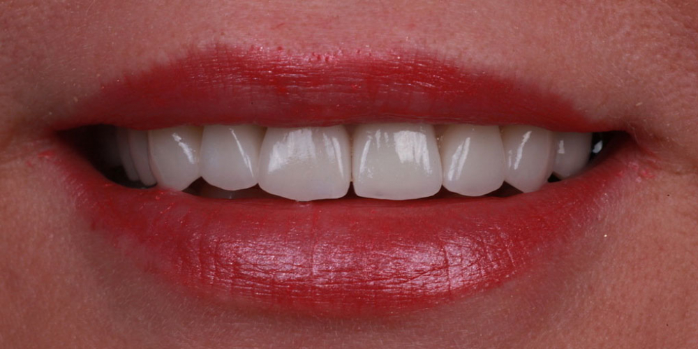  Протезирование зубов керамическими винирами и керамической коронкой на имплантате