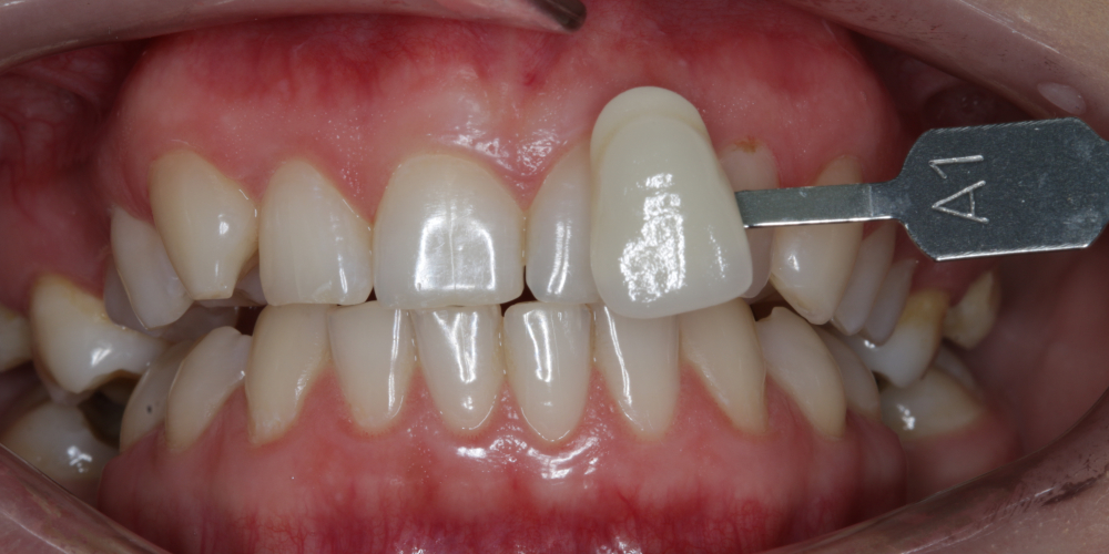  Результат отбеливания зубов ZOOM-4 с A1 до 0M
