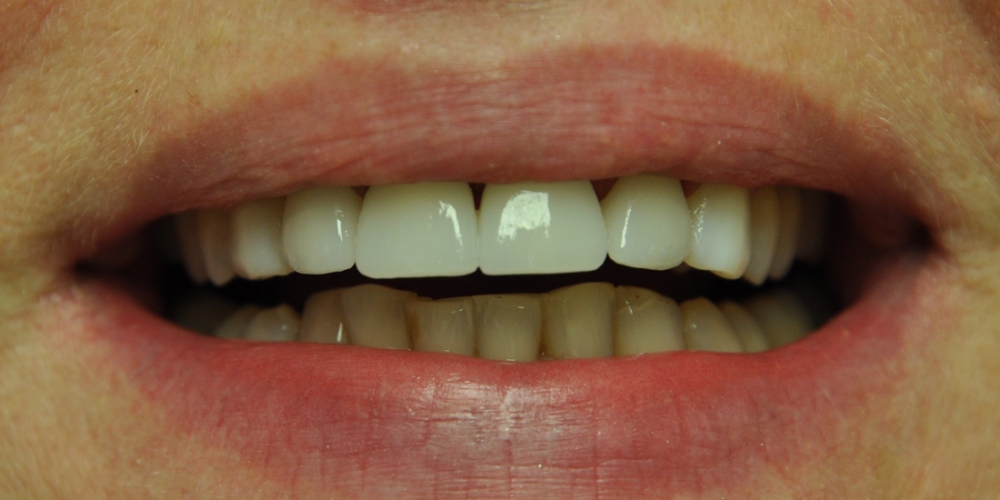  Пигментированные реставрации на зубах фронтальной группы