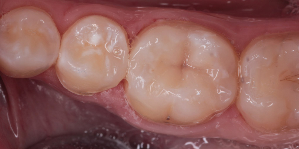  Художественная реставрация, замена старой пломбы на жевательном зубе