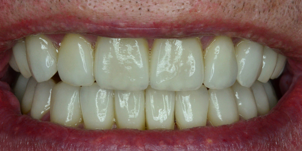  Восстановление зубов с помощью имплантов и керамических коронок 