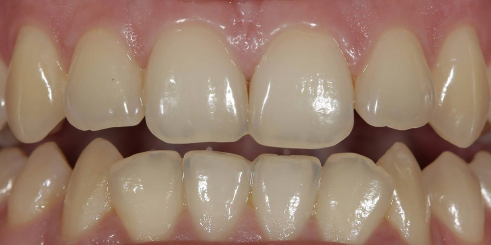  Результат отбеливания зубов ZOOM, решение проблемы дисколорита зубов