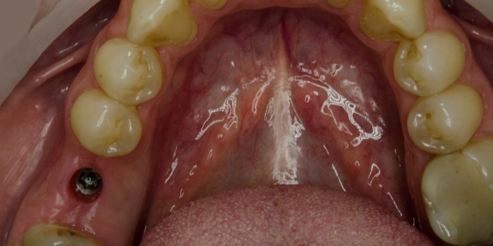  Имплантация Альфа Био одного зуба + металлокерамическая коронка