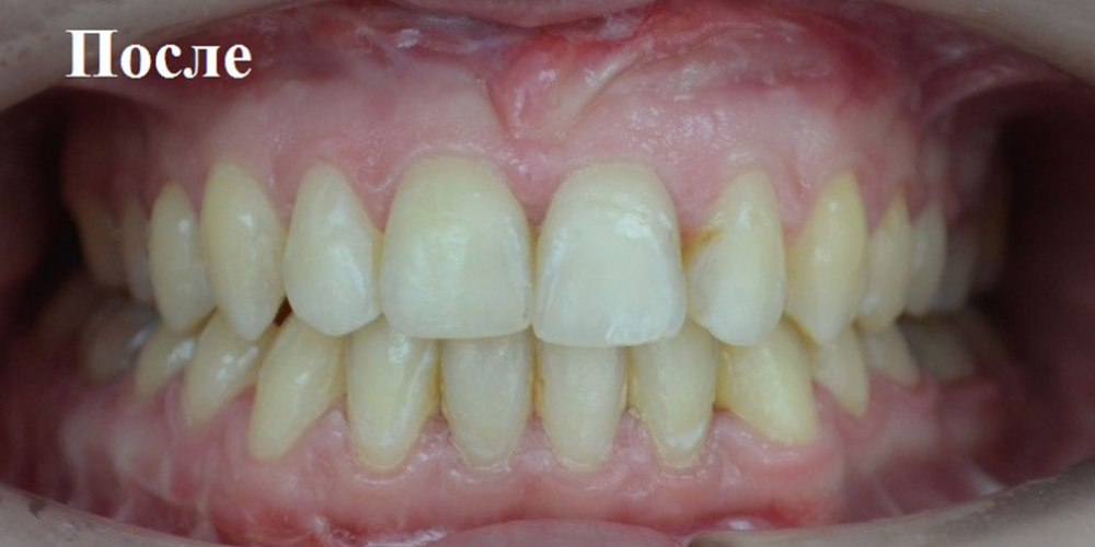  Исправление положения челюстей и неправильного положения зубов