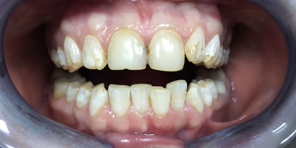  Установка виниров на зубы верхней и нижней челюсти