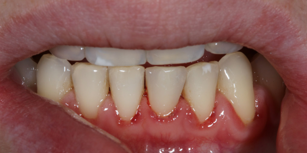  Терапевтический винир, микродентия зуба