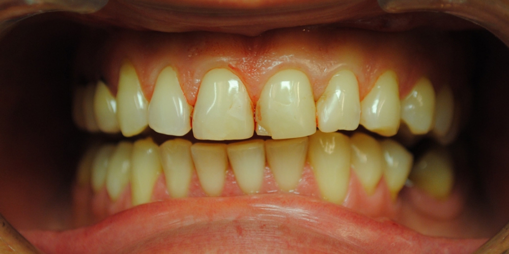  Заменены композитные реставрации на зубах фронтальной группы
