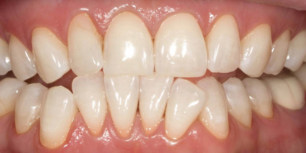  Отбеливания зубов по безопасной технологии SmartLight 3LT