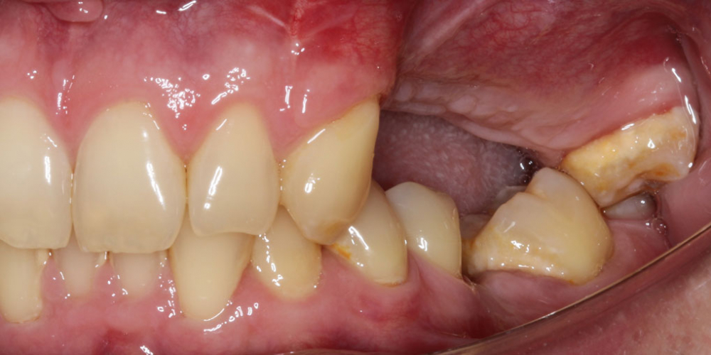 Отсутствие зубов в течение длительного времени, затрудненное пережевывание пищи, эстетический дефект