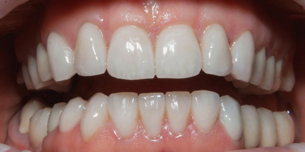  Установка керамических виниров на зубы, пациентке 54 года