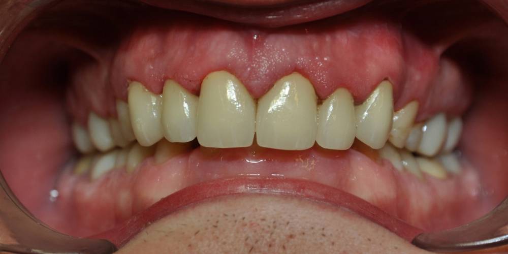  Замена множественных реставраций на зубах фронтальной группы на частичные коронки E-max
