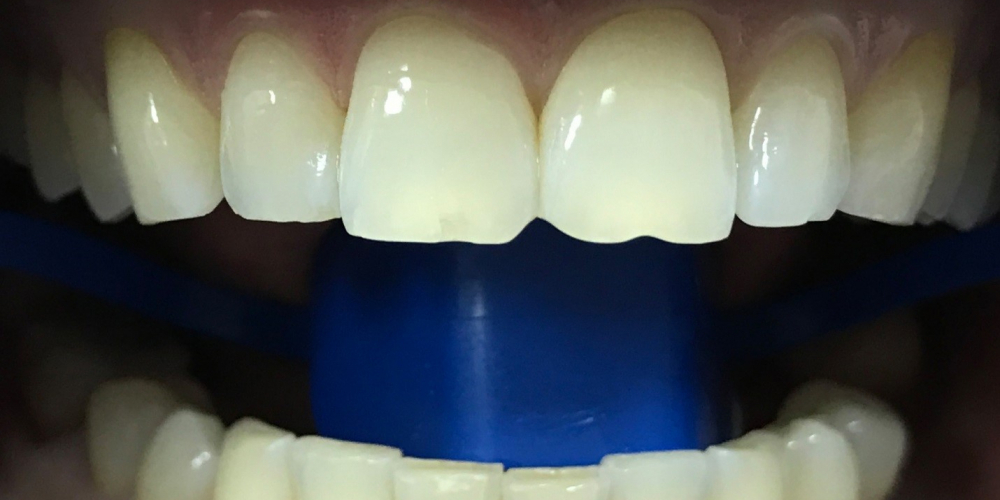  Отбеливание зубов системой ZOOM 3