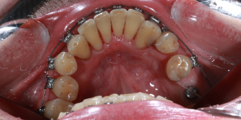 Профессиональная гигиена полости рта в процессе ортодонтического лечения фото после лечения