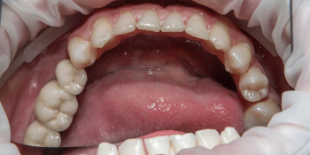Имплантация и протезирование 3-х зубов из диоксида циркония фото после лечения