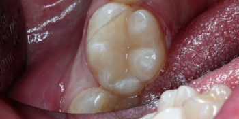 Лечим кариес на жевательном зубе фото после лечения