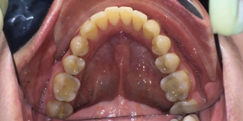 Результат исправления кривых зубов с помощью брекетов фото после лечения