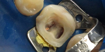 Реставрация разрушенного зуба фото до лечения
