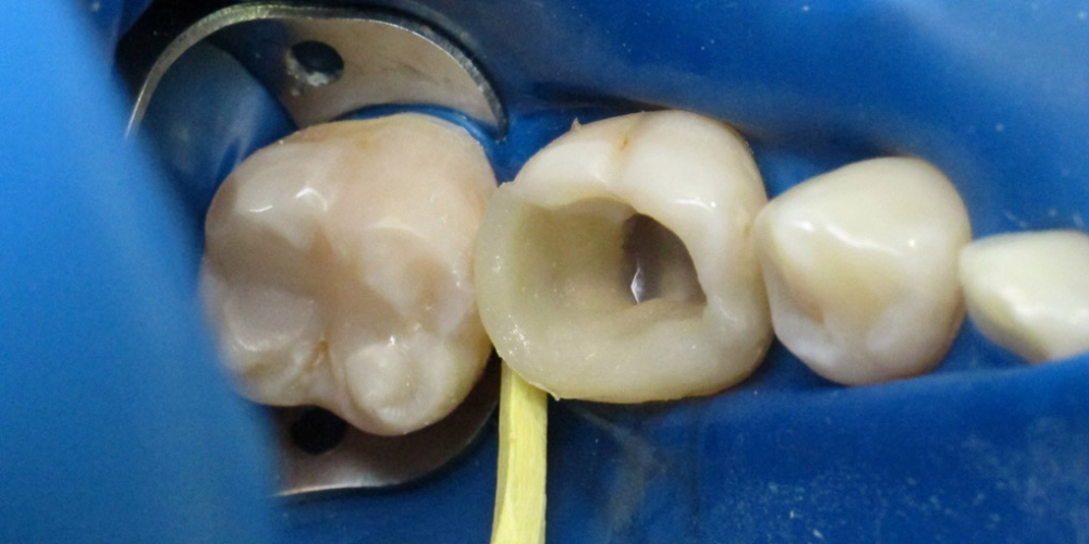  Реставрация разрушенного зуба