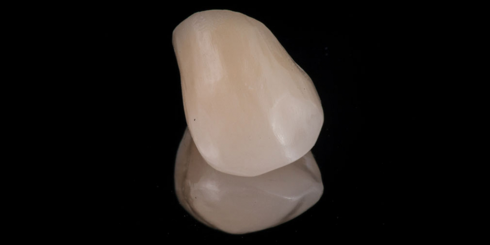 Восстановление утраченных тканей зуба коронкой Cerec