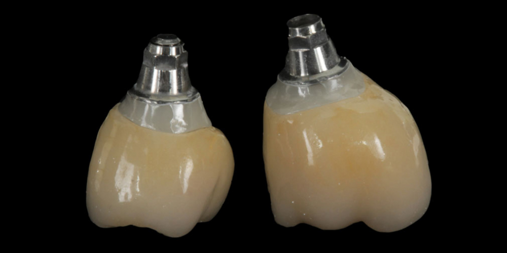 готовая работа (цельнокерамические реставрации и имплантатах с опорой на индивидуальные циркониевые абатменты) Цельнокерамические реставрации на зубах и имплантатах с опорой на индивидуальные абатменты
