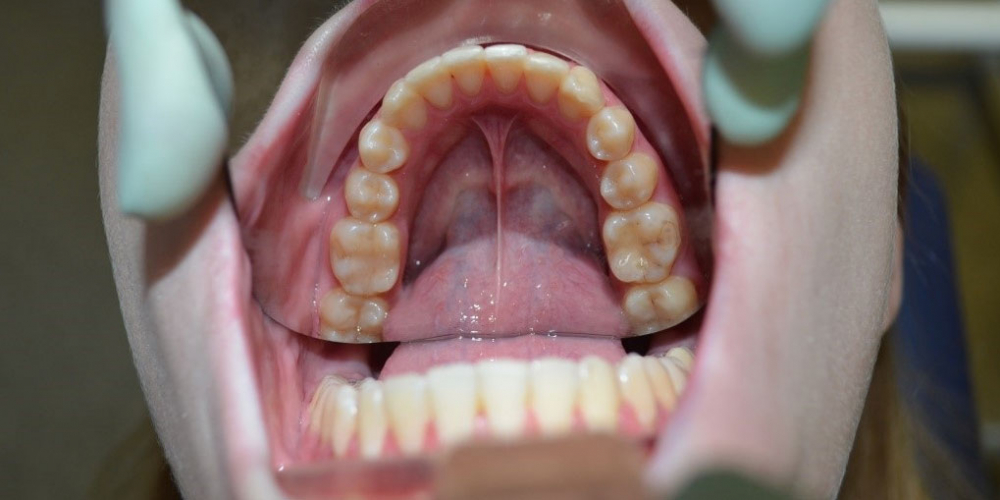 После лечения. Результат выравнивания зубов на нижней и верхней челюстях