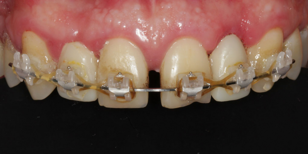 Этап ортодонтического лечения (исправление прикуса). Эстетическое протезирование передних верхних зубов с предварительным исправлением прикуса и импланта
