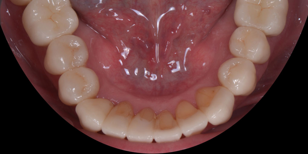 Готовая работа - нижняя челюсть. Тотальная стоматологическая реабилитация пациента: 6 дентальных имплантов, 28 керамических виниров