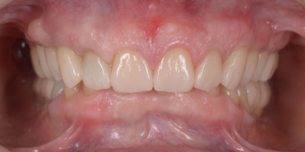 Готовая работа (цельнокерамические реставрации на зубах и имплантатах с опорой на индивидуальные циркониевые абатменты) в полости рта. Тотальная стоматологическая реабилитация пациента: 12 имплантов + 28 виниров