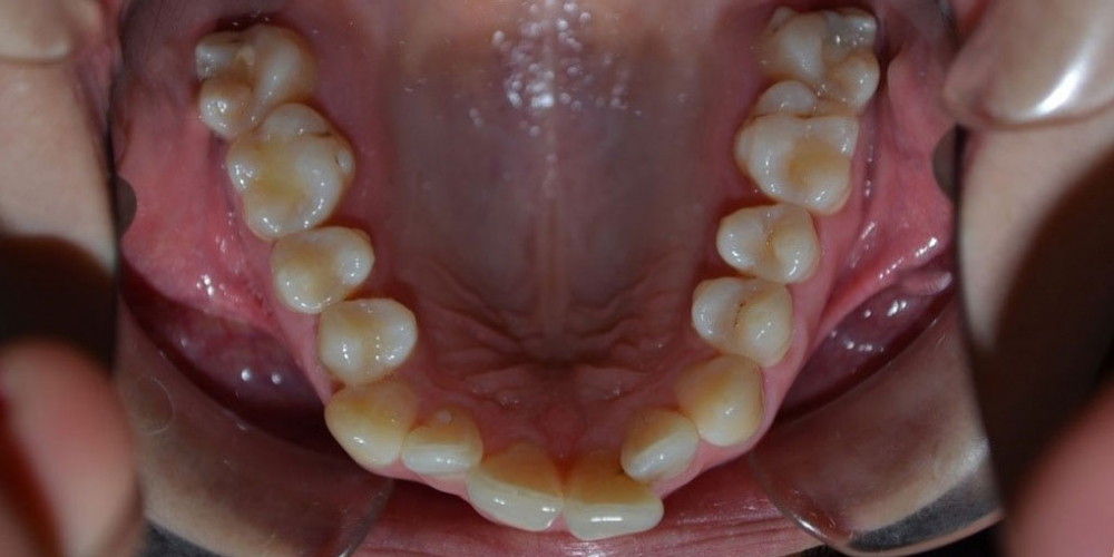 Результат исправления кривых зубов с помощью брекетов