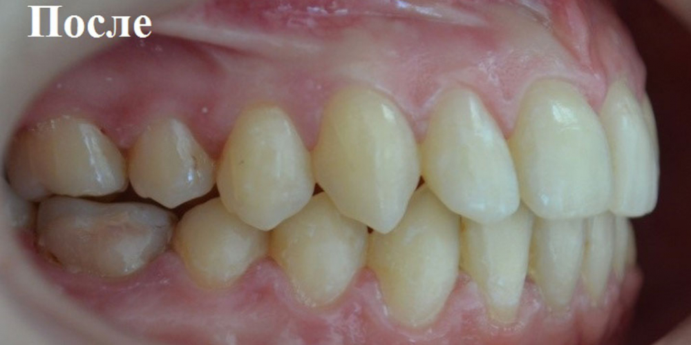  Исправление положения челюстей и неправильного положения зубов