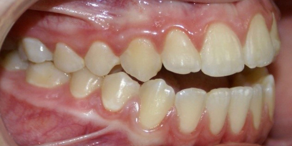  Результат исправления неровности зубов на верхней и нижней челюстях