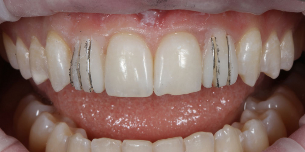препарирование зубов через mock - up Исправление боковых резцов верхней челюсти керамическими винирами