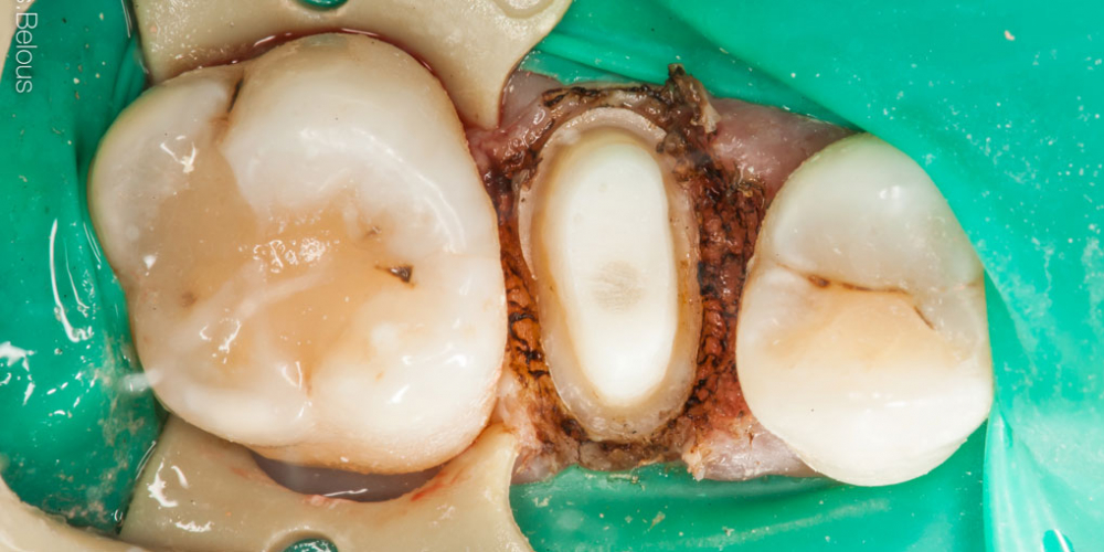 Коронка по технологии CEREC из литий силикатной керамики E.max с индивидуализацией