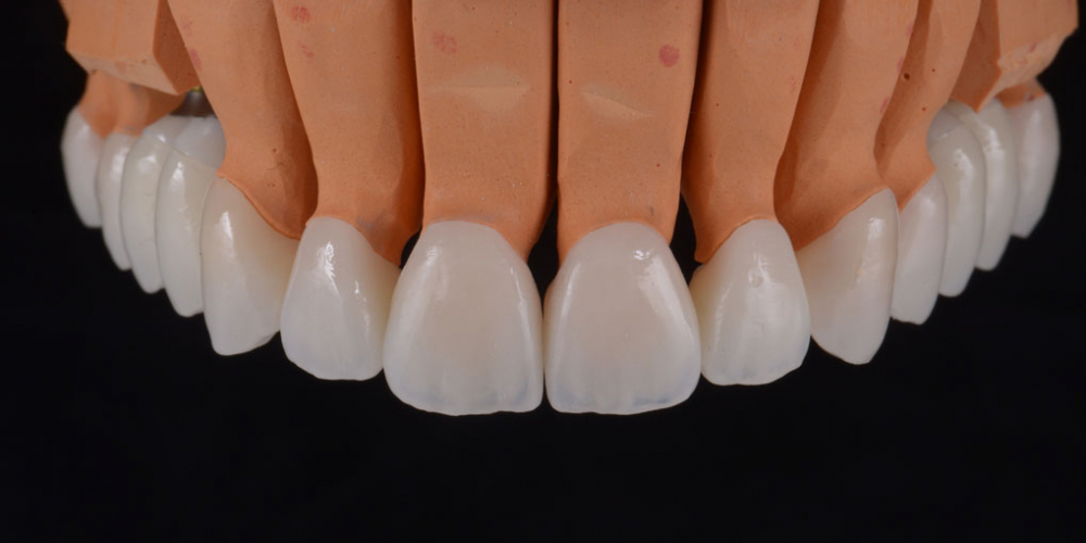 Цельнокерамические реставрации на зубы (виниры, коронки) и импантаты на индивидуальных абатментах из диоксида циркония на модели - верхняя челюсть. Тотальная реабилитация пациента, 5 имплантов, 28 виниров