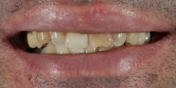 Исправление неровности зубного ряда и дисколорита при помощи 4-х керамических виниров фото до лечения