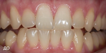 Фотографии отбеливания зубов по технологии ZOOM-4 фото до лечения